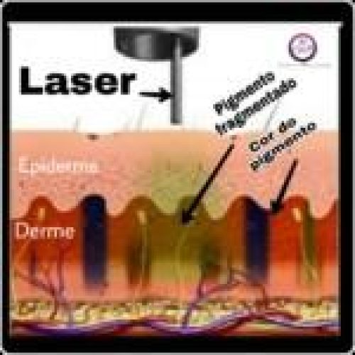 REMOÇÃO COM LASER